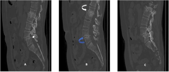 Preoperative sagittal CT of lumbar spine demonstrating butterfly vertebra and dysraphism