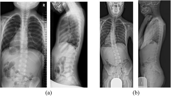 Full-length standing spine radiograph demonstrating progressive congenital scoliosis