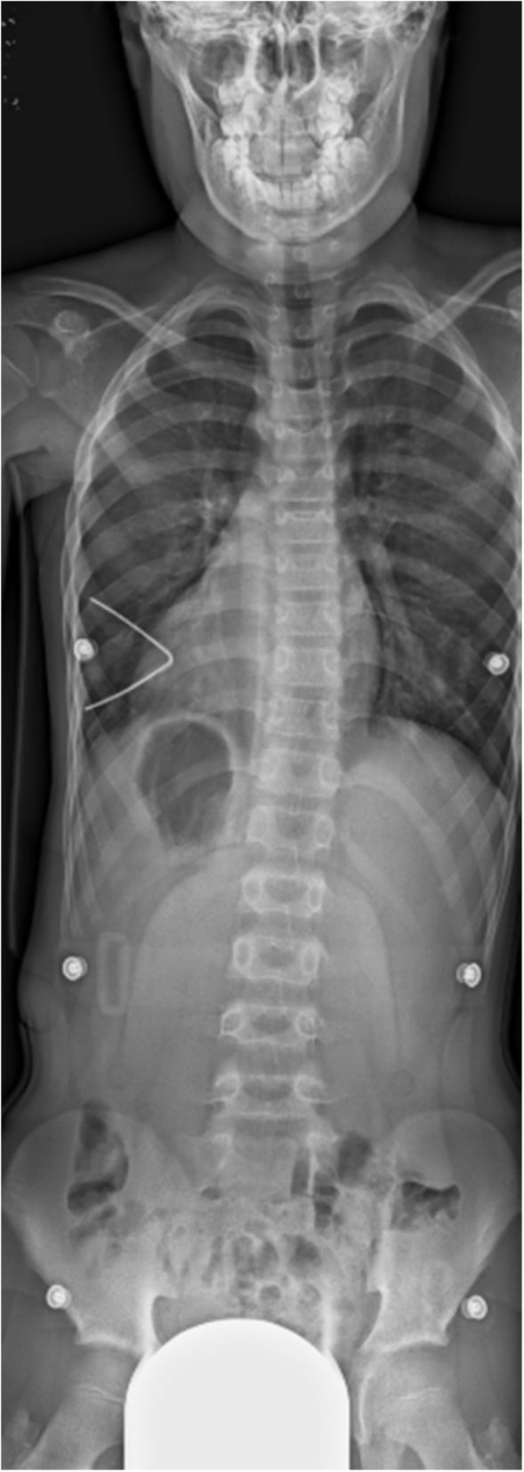 In-brace full-length spine radiograph demonstrating scoliosis correction