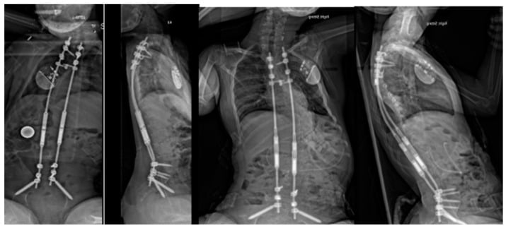 Serial radiographs showing sustained curve control with magnetically controlled growing rods