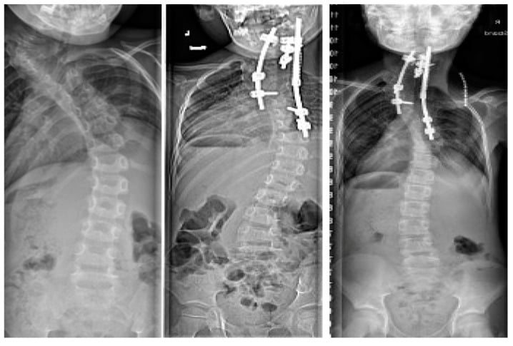 Serial radiographs showing gradual correction with a spring distraction system