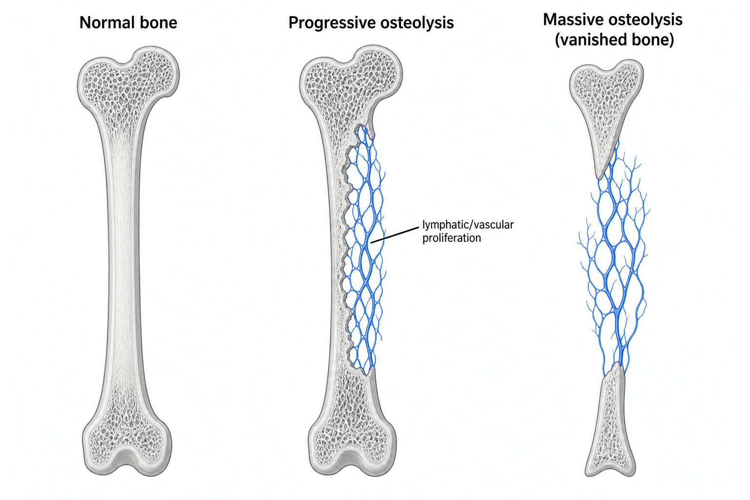 Three-stage illustration of Gorham-Stout disease showing normal bone, progressive osteolysis with lymphatic/vascular proliferation, and massive osteolysis with vanished bone