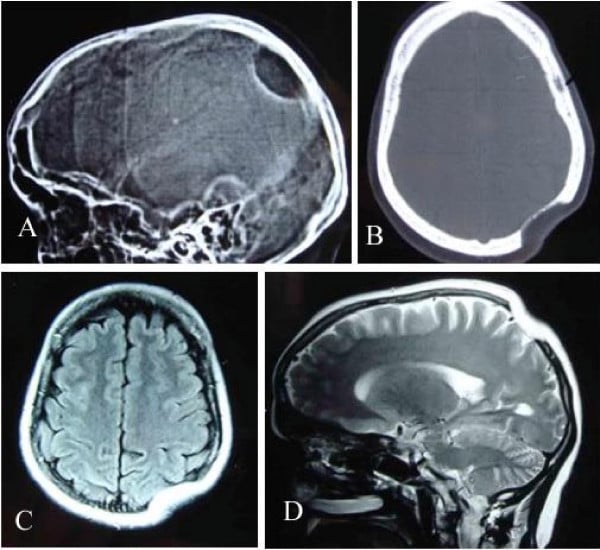 Skull radiograph and CT of Gorham-Stout disease showing an osteolytic defect of the parietal bone