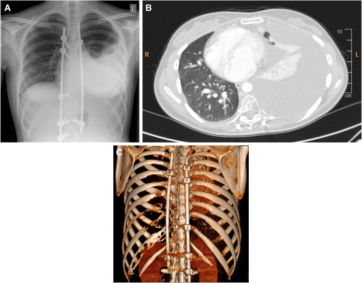 Chest radiograph and CT showing a large pleural effusion with mediastinal shift in Gorham-Stout disease after spinal surgery, with 3D reconstruction of the instrumented thoracic cage