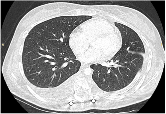 Chest CT showing resolution of the pleural effusion with a chest drain in situ after treatment of Gorham-Stout chylothorax