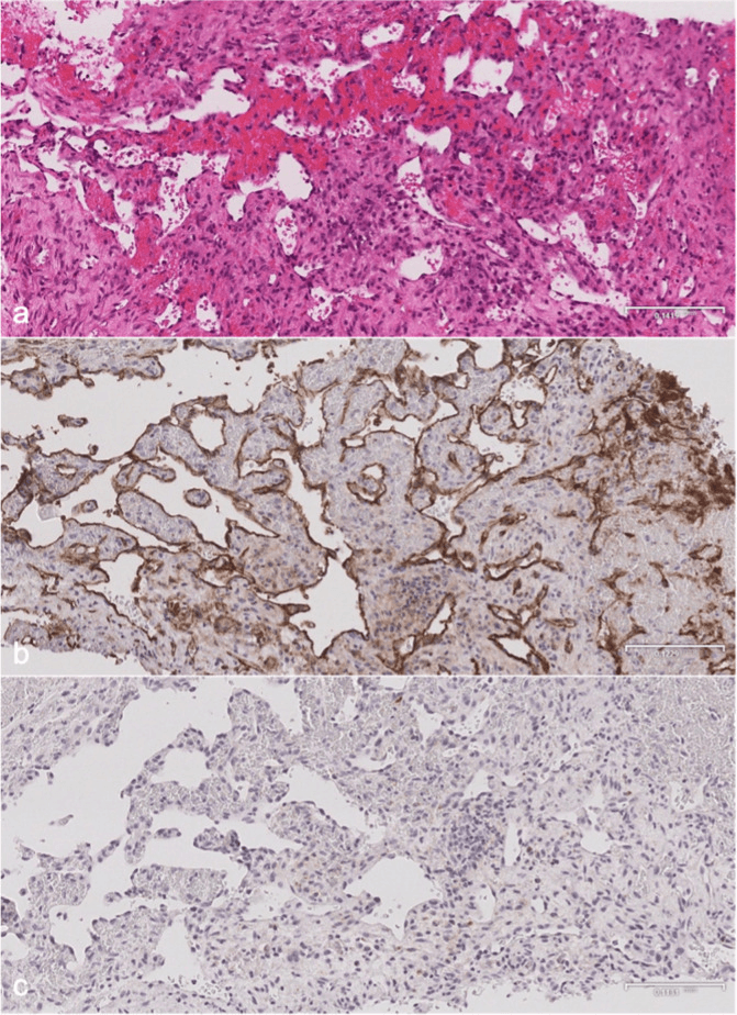 Histology of a Gorham-Stout bone biopsy showing anastomosing vascular channels with CD31-positive endothelium