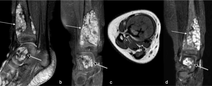 MRI of the distal leg and hindfoot showing multilobulated avidly enhancing T2 hyperintense lesions in Gorham-Stout disease