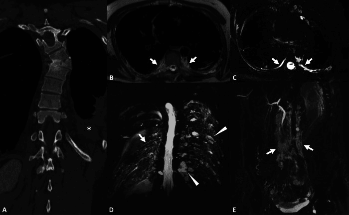 Coronal CT showing osteolysis of half the T7 vertebral body with a pleural effusion, alongside MR lymphography of the thoracic duct