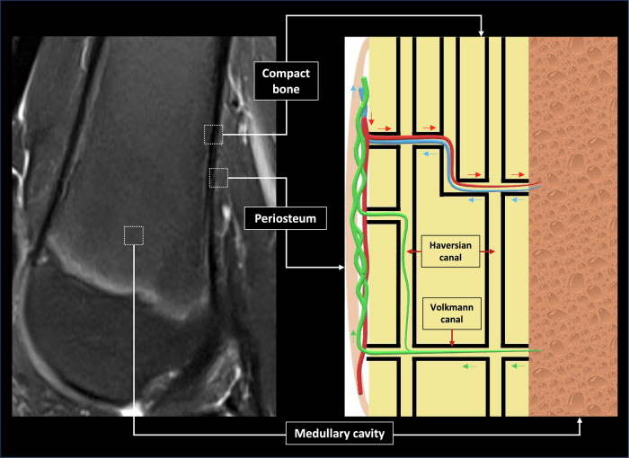 Schematic of hypothesised intraosseous lymphatic channels alongside a corresponding knee MRI