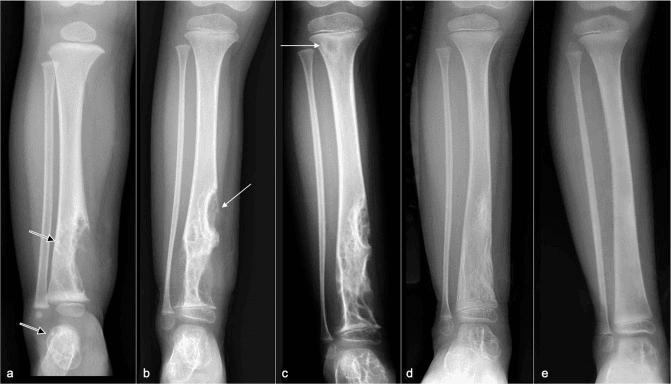 Serial radiographs of the distal tibia over three years showing progressive osteolysis in Gorham-Stout disease