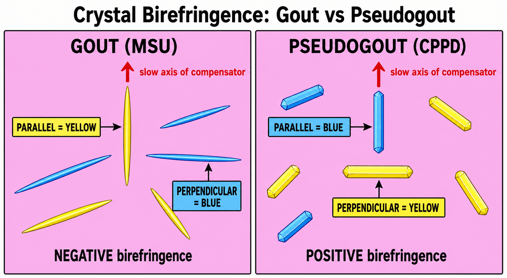 Two-panel schematic of crystal birefringence: gout MSU needles (negatively birefringent, yellow parallel to the compensator slow axis) versus pseudogout CPPD rhomboids (positively birefringent, blue parallel).
