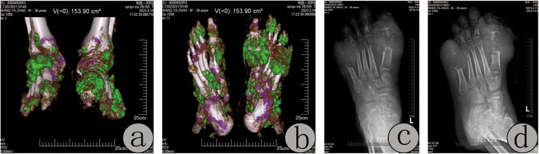 Dual-energy CT volume-rendered scan demonstrating monosodium urate crystal deposition in gout