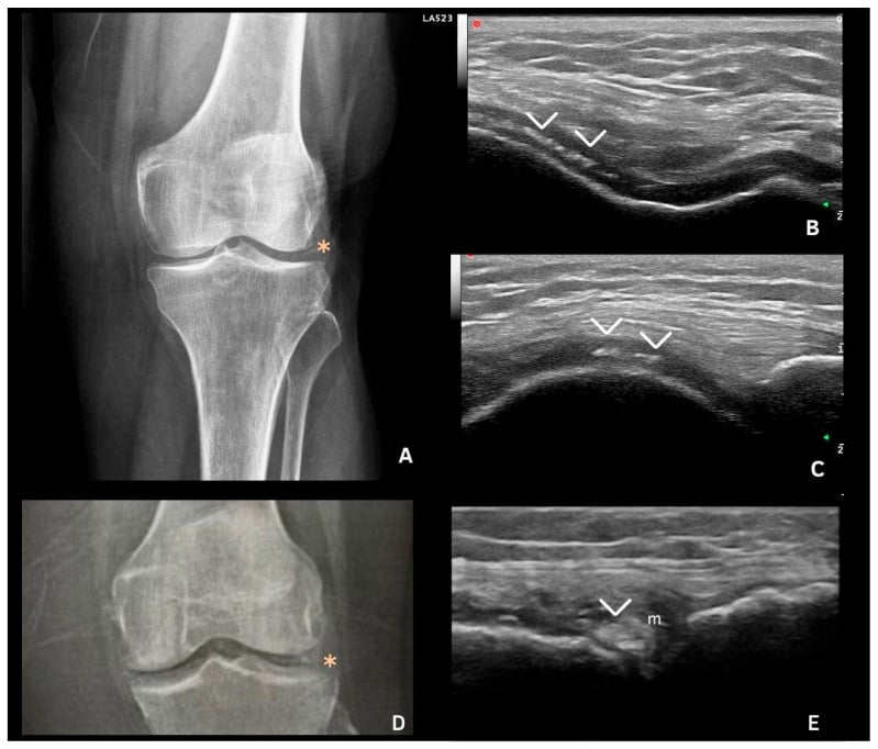 Knee radiograph and ultrasound demonstrating chondrocalcinosis in CPPD disease