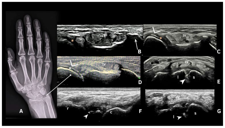 Wrist radiograph and ultrasound demonstrating CPPD crystal deposition