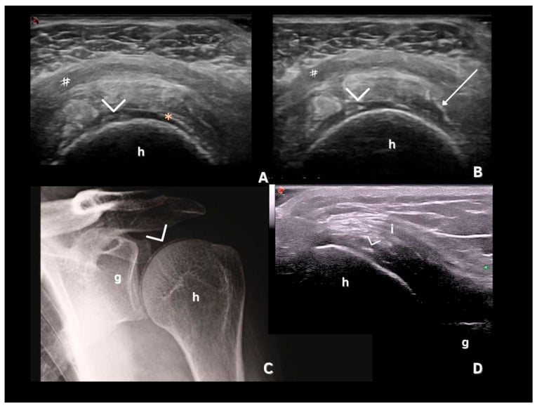 Shoulder radiograph and ultrasound demonstrating crystal deposition arthropathy