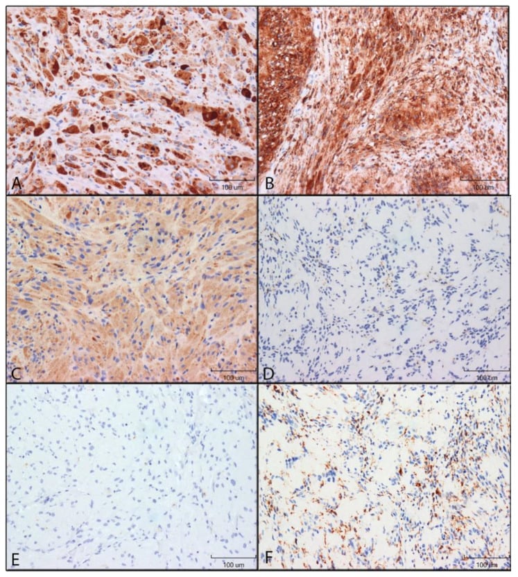 Antigen-presenting cell marker comparison in granular cell tumours and schwannomas