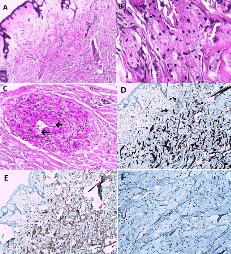Cutaneous granular cell tumour with perineural and perivascular infiltration
