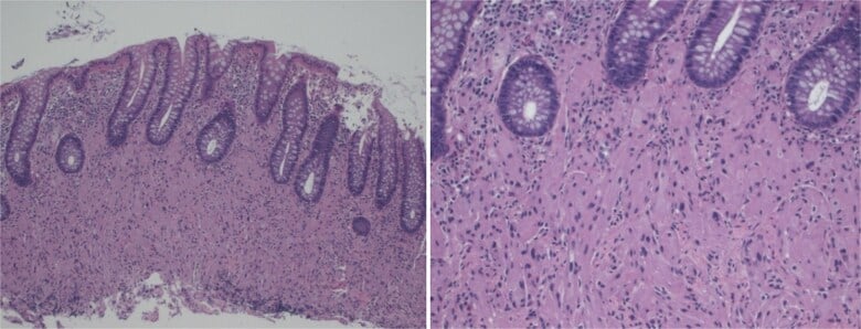 Histology of a granular cell tumour showing bland cells with abundant eosinophilic granular cytoplasm
