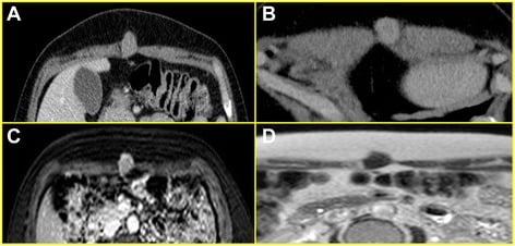 CT and MRI of an intramuscular granular cell tumour in rectus abdominis