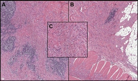 Intramuscular granular cell tumour infiltrating fibrous stroma and skeletal muscle