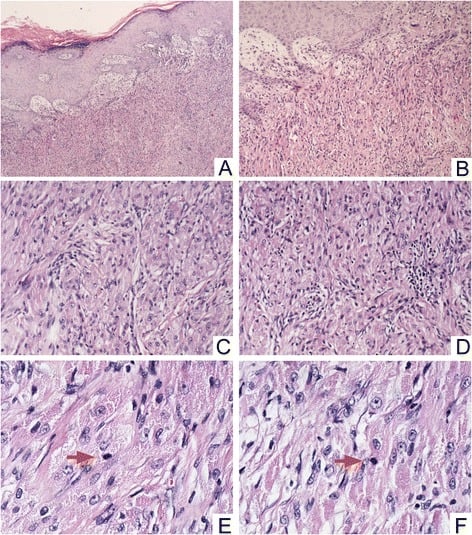 Malignant granular cell tumour with spindling pleomorphism nucleoli and mitoses