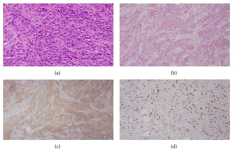 Malignant granular cell tumour histology with mitoses and S100 CD68 and Ki-67 staining