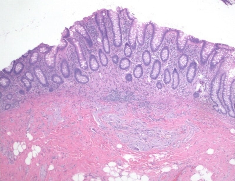 Low-power histology showing granular cell tumour in mucosa and submucosa