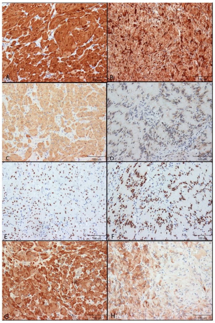 Neural marker comparison between granular cell tumours and schwannomas