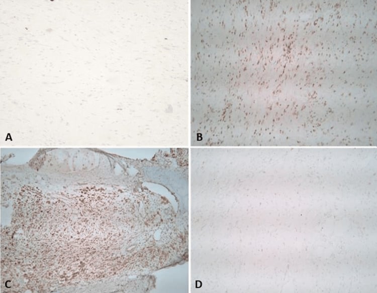 S100-negative non-neural granular cell tumour immunohistochemical panel