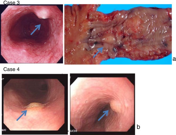 Endoscopic appearances and resection specimens of oesophageal granular cell tumours