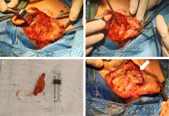 Operative excision and gross specimen of a postauricular granular cell tumour