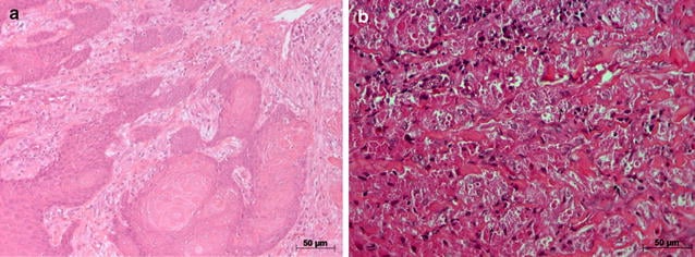 Granular cell tumour with severe pseudoepitheliomatous hyperplasia