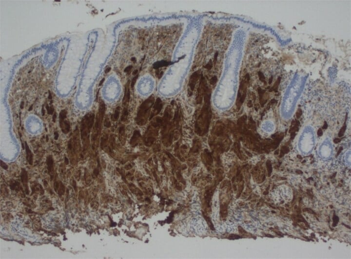 S100 immunostain showing diffuse strong positivity in a granular cell tumour, confirming Schwann-cell origin