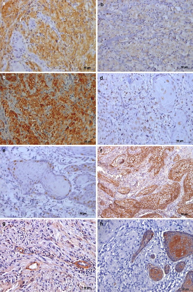 S100 vimentin CD68 and inhibin immunohistochemical panel in granular cell tumour