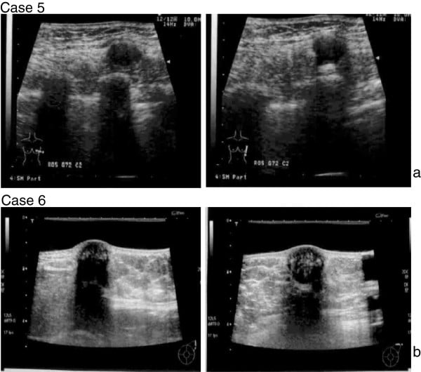 Ultrasound appearances of intramuscular granular cell tumours