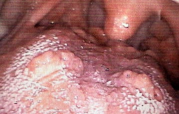 Post-excision intraoral view after removal of a tongue granular cell tumour