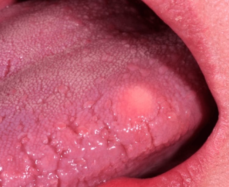 Firm submucosal granular cell tumour on the dorsal tongue