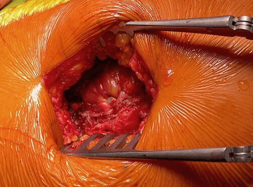 Double-row crossed-limb gluteus medius reconstruction