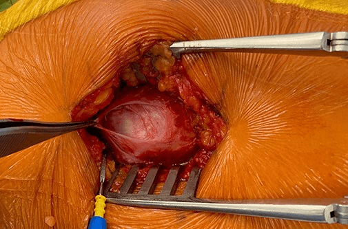 Open view of a full-thickness gluteus medius tear after bursectomy