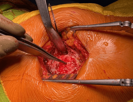 Debridement and preparation of the gluteus medius footprint