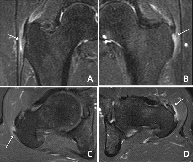MRI spectrum from gluteus medius tendinosis to partial tear