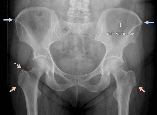AP pelvis radiograph with arrows marking gluteal tendon calcification at the iliac crests and around the greater trochanters