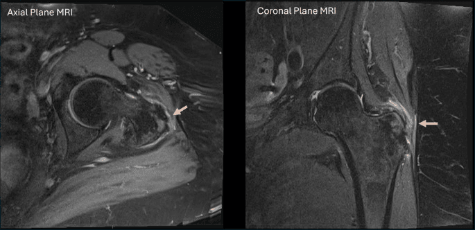 Axial and coronal MRI of combined gluteus medius and minimus tears