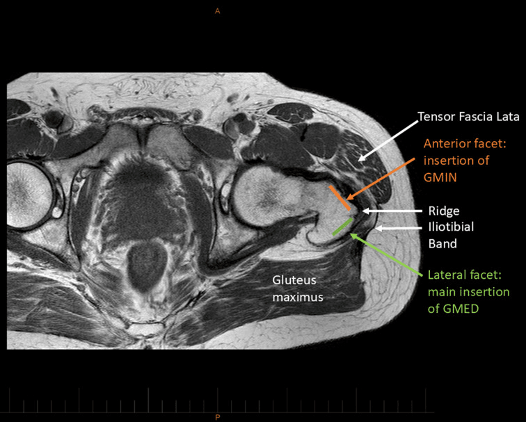 Labelled axial MRI showing the anterior and lateral trochanteric facets and the overlying iliotibial band
