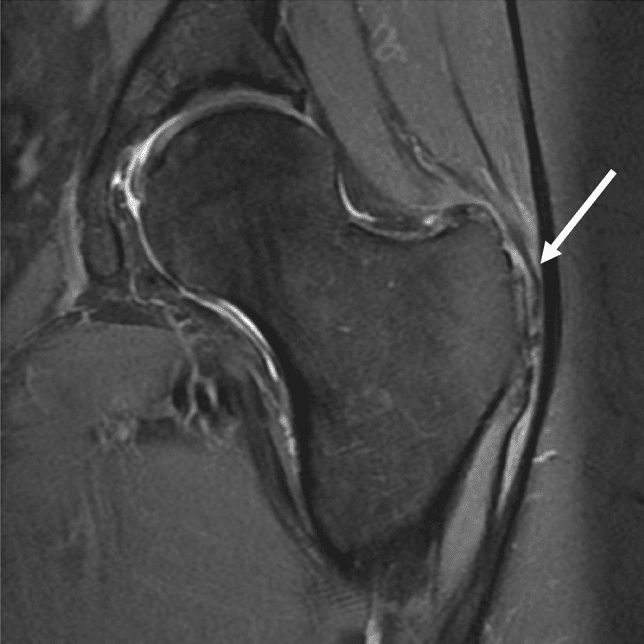 Coronal MRI showing high signal at the greater trochanter (arrow) in GTPS