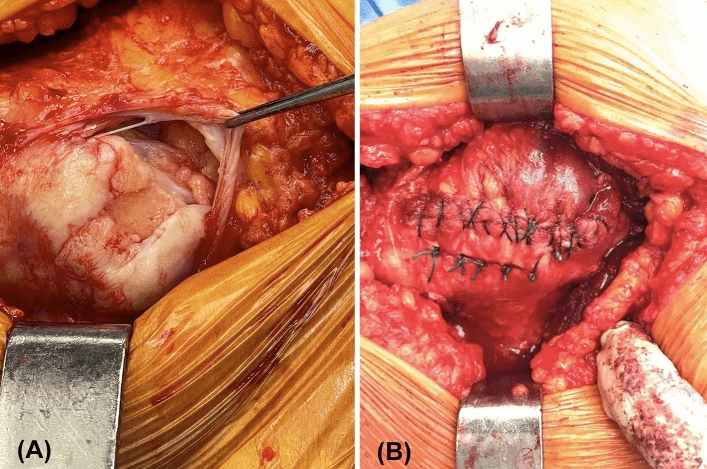 Open hip-abductor tear before and after augmented repair
