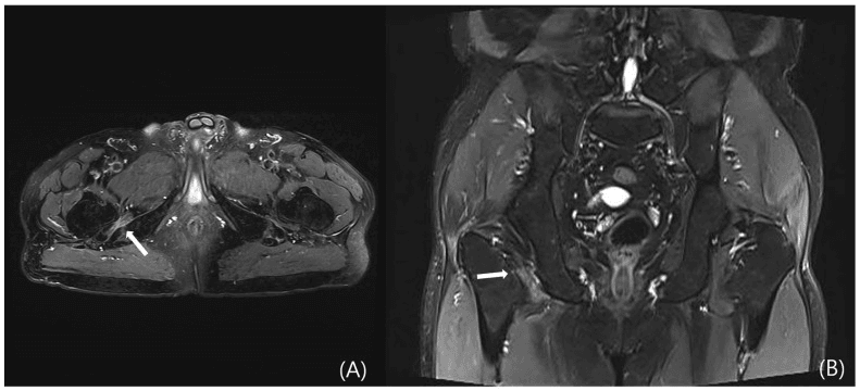 Axial and coronal MRI showing quadratus femoris oedema in ischiofemoral impingement