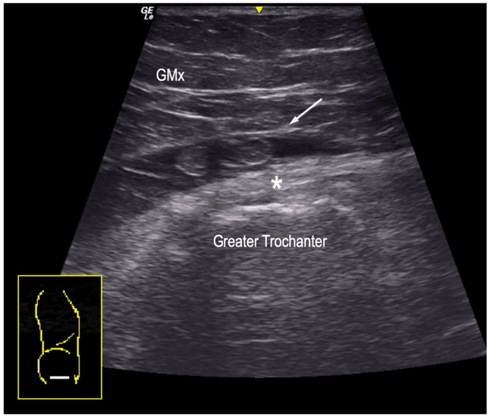 Short-axis ultrasound of traumatic subgluteus-maximus bursal distension