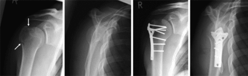 Plate fixation alternative for GT fracture