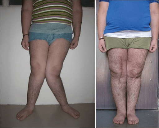 Clinical comparison showing correction of severe genu valgum